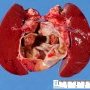 Parasplenic cyst