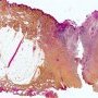 Cutaneous fistula complicating a chronic osteomyelitis