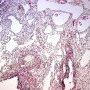 Pleuropulmonary blastoma type 1