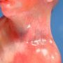 Caudal regression syndrome with lombosacral agenesis