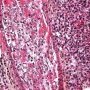 Fungal vasculitis in systemic invasive aspergillosis