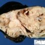 Intra-abdominal immature teratoma