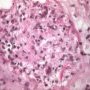 Cutaneous leishmaniasis