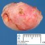 Axilary mammary fibroadenoma