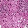 Hepatic granuloma (Etiology unknown)
