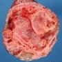 Cystic partially differentiated nephroblastoma