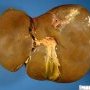 Cholestatic liver