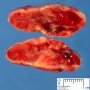 Cellular schwannoma