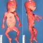 Thick neck in trisomy 21 (fetus 19 weeks)