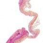 Aortic dissection in Marfan disease