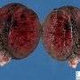 Hemorrhagic necrosis of the testis after torsion