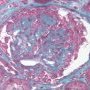 Collpasing glomerulopathy (trichrome stain)