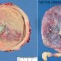 Placenta in acute chorioamnionitis