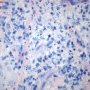 Cutaneous leishmaniasis