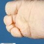 Foot oligodactyly