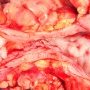 Colonic stenosis in Crohn disease
