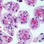 Placental mucolipidosis