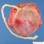 Placenta circumvallata with marginal insertion