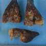 Extralobar pulmonary sequestration
