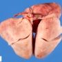 Dextrocardia in situs inversus (24 weeks)