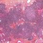 Pulmonary nodular lymphoid hyperplasia