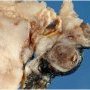 Tumoral thrombosis of the renal vein (suprarenal neuroblastoma)