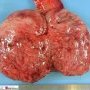 Seminoma of the testis