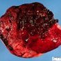 Retroplacental hematoma