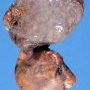 Pleuropulmonary blastoma type 1