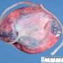 Long umbilical cord (37cm for normal at 15cm at 15 weeks)