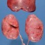 Bilateral nephromegaly in ARPKD