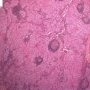 Thymic seminoma