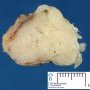Mammary fibroadenoma