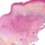 Epithelioid sarcoma