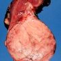 Wilms tumor (nephroblastoma) of renal inferior pole