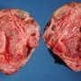 Cystic partially differentiated Wilms tumor