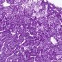 Niemann-Pick disease type B (NPB) (PAS)