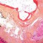 Epithelioid sarcoma