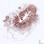 SMA immunostaining in lymphangiomyoma (lymphangioleiomyoma)