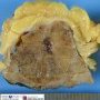 Renal oncocytoma