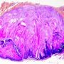 Pilomatrixoma. Slide. HE x1