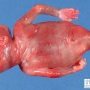 Sirenomelia with anal imperforation, genital agenesis and vesico-urethral (...)