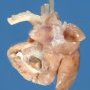 Aortic arch hypoplasia and endocarcial fibroelastosis with left ventricular (...)