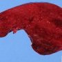 Normal spleen (splenectomy for thrombocytopenia)