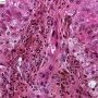Epithelial dysplasia of interlobular biliary tract in chronic hepatic (...)