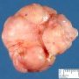 Mammary fibroadenoma