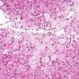 Niemann-Pick disease type B (NPB)