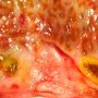 Dilatation of bile ducts in extrahepatic biliary tract atresia