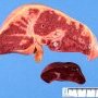 Liver ischemia in neonatal shock with DIVC