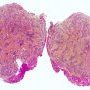 Intramuscular lobular capillary hemangioma
